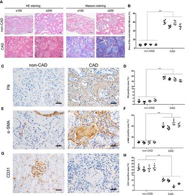 Impaired ATG16L-Dependent Autophagy Promotes Renal Interstitial Fibrosis in <mark class="highlighted">Chronic Renal Graft Dysfunction</mark> Through Inducing EndMT by NF-κB Signal Pathway